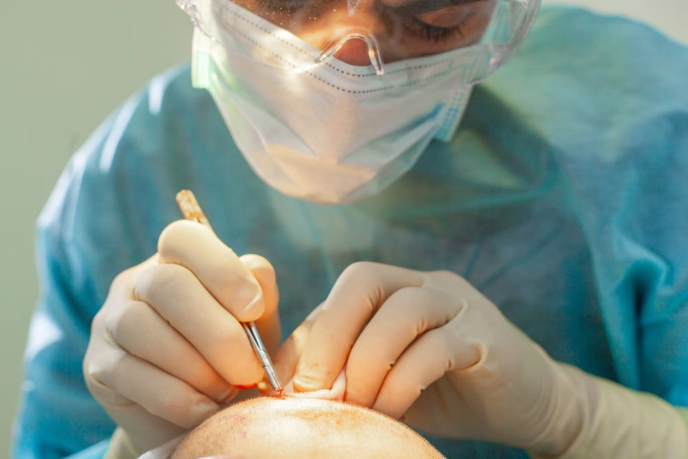 Türkei: Das Millionengeschäft mit den Haartransplantationen